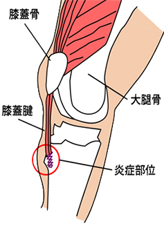 オスグッド・シュラッター病